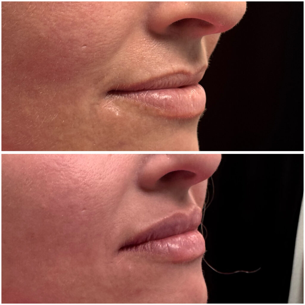 Lip filler of before after