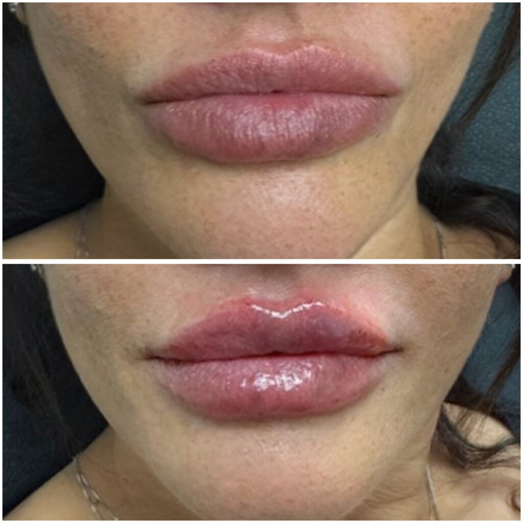 Lip filler of before after