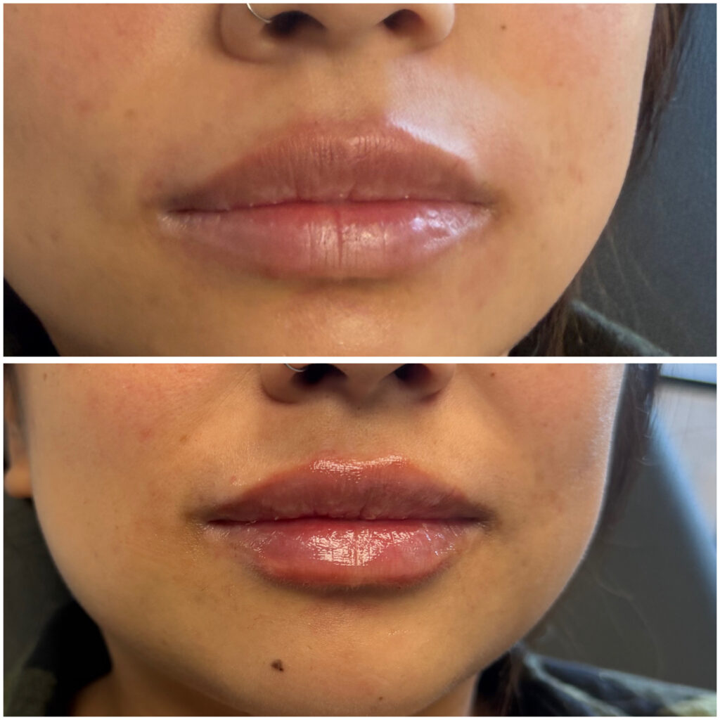 Lip filler of before after