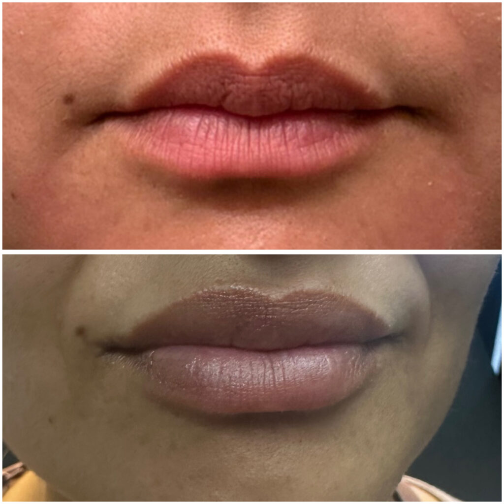 Lip filler of before after